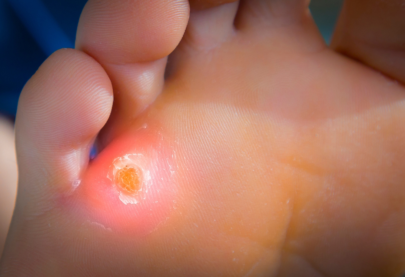 Calluses on foot