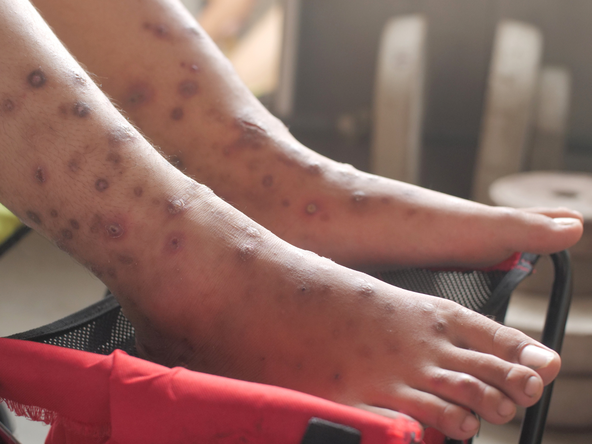 Foot with ulcer filled with pus condition caused of scabies infection, sensitive skin itchy health problem