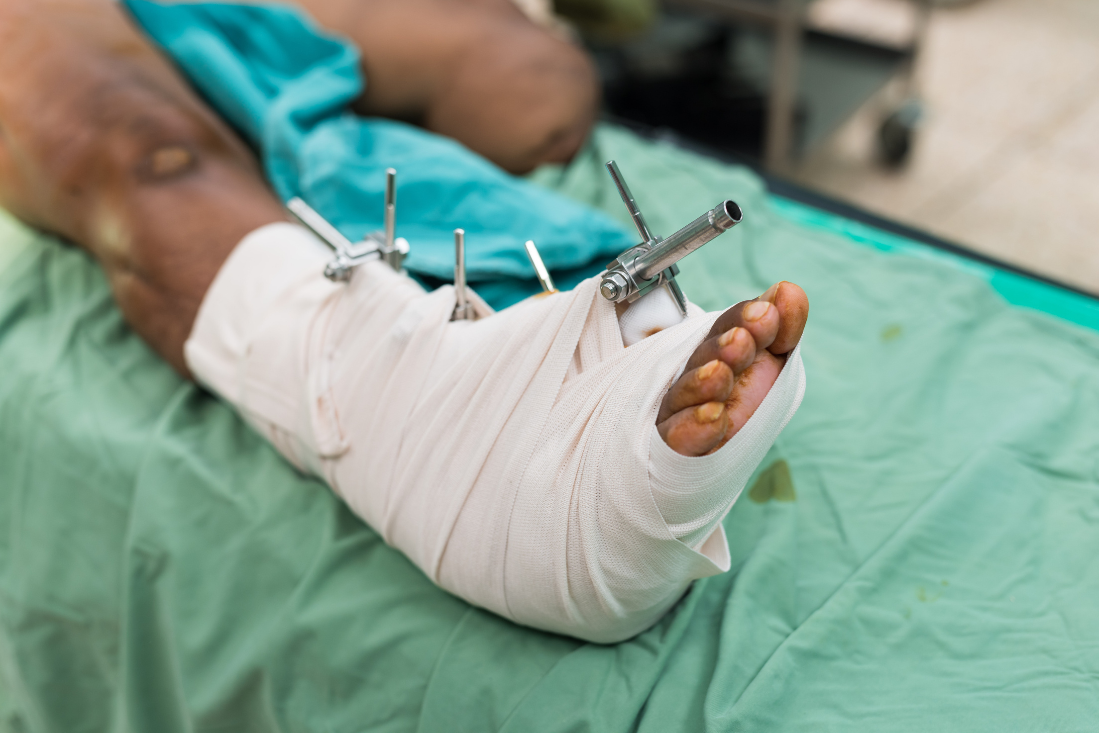 External Fixation on Injured Foot